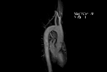 mrt_angio_aorta.gif