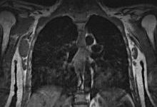 mrt_thorax_axilla_tumor.jpg