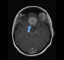 neuro_meningeom.jpg