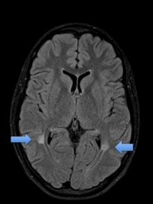 neuro_ms_plaque.jpg