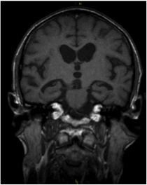 neuro_temporale_atrophie.jpg