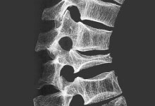 osteoporose.jpg